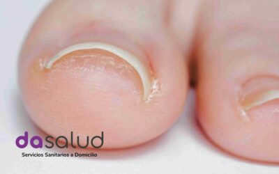 Uñas encarnadas en la tercera edad: Tratamiento profesional por un podólogo.